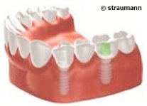 Bild 2: Implantatgetragene Brücke Image